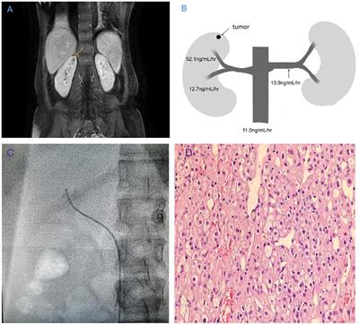 Renal venous sampling assisted the diagnosis of juxtaglomerular cell tumor: a case report and literature review